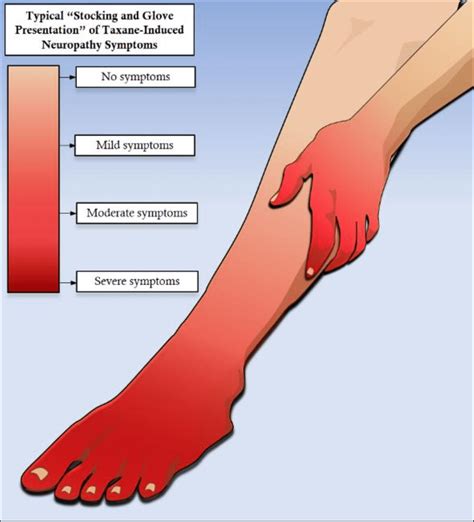 stocking glove syndrome|Numbness